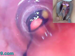 Câmera do endoscópio para o endoscópio da bexiga de uma mulher madura com balões (Bizarro Japonês Sexo Filme)